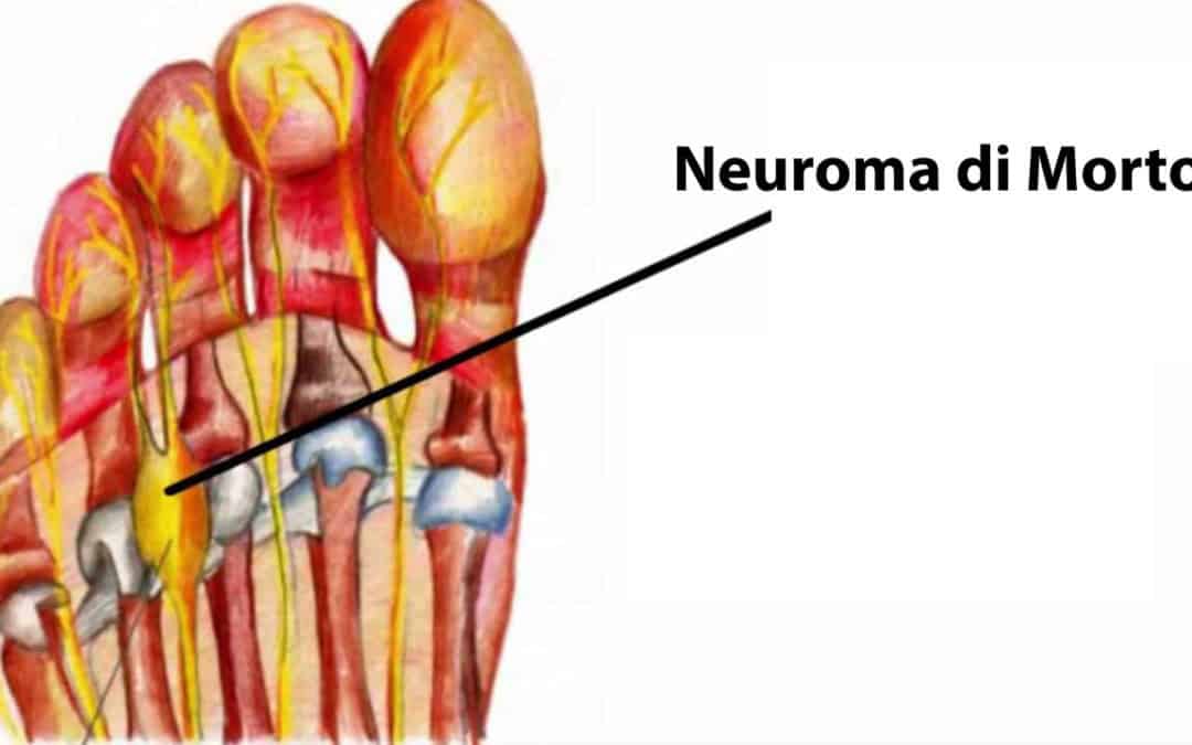 morbo di morton | www.fisiomakbi.it
