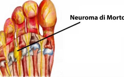 Neuroma di Morton
