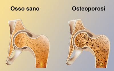 Osteoporosi