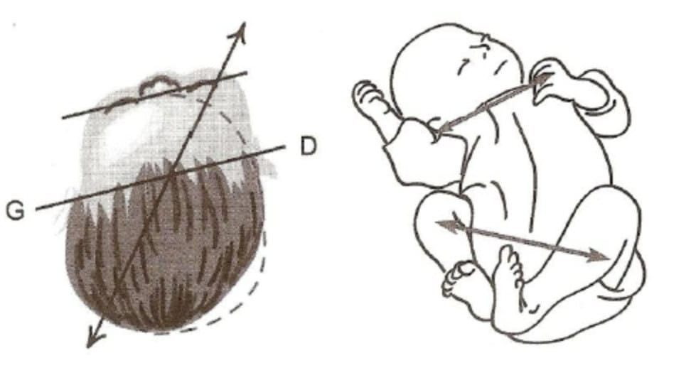 torcicollo neonatale